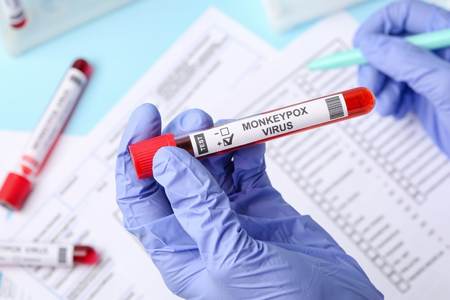 Paran chega a 19 casos de monkeypox; Brasil tem 813